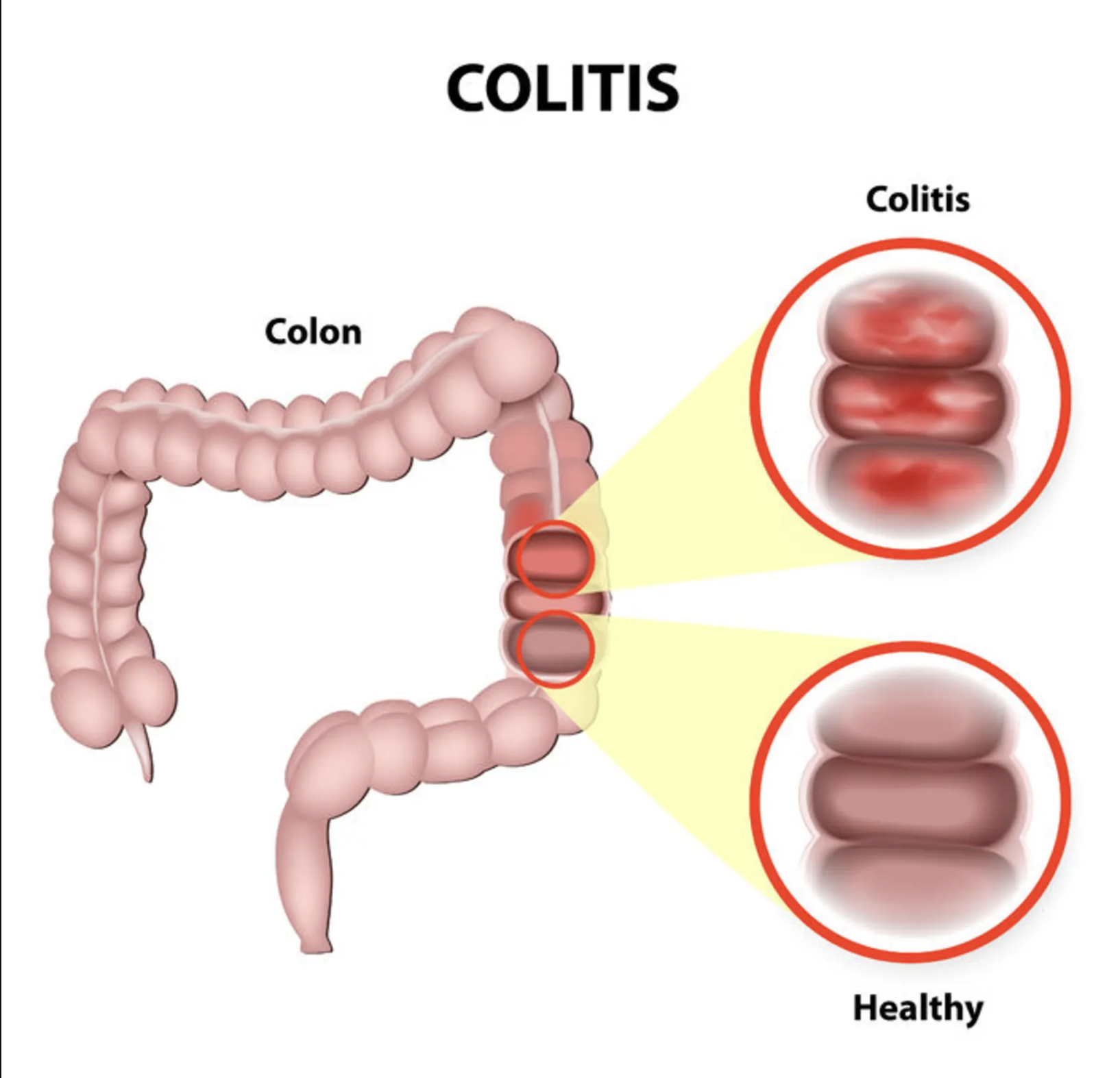Viêm đại tràng - Nguy cơ, Triệu chứng và Điều trị