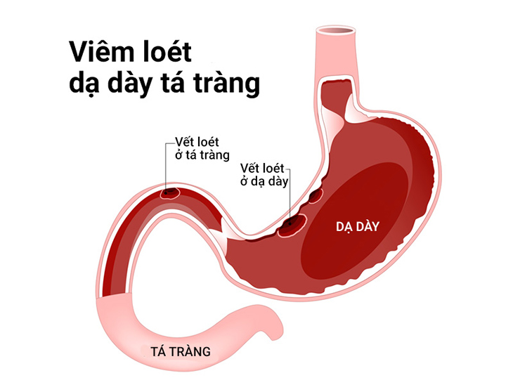 Làm sao để phát hiện sớm bệnh viêm loét dạ dày?