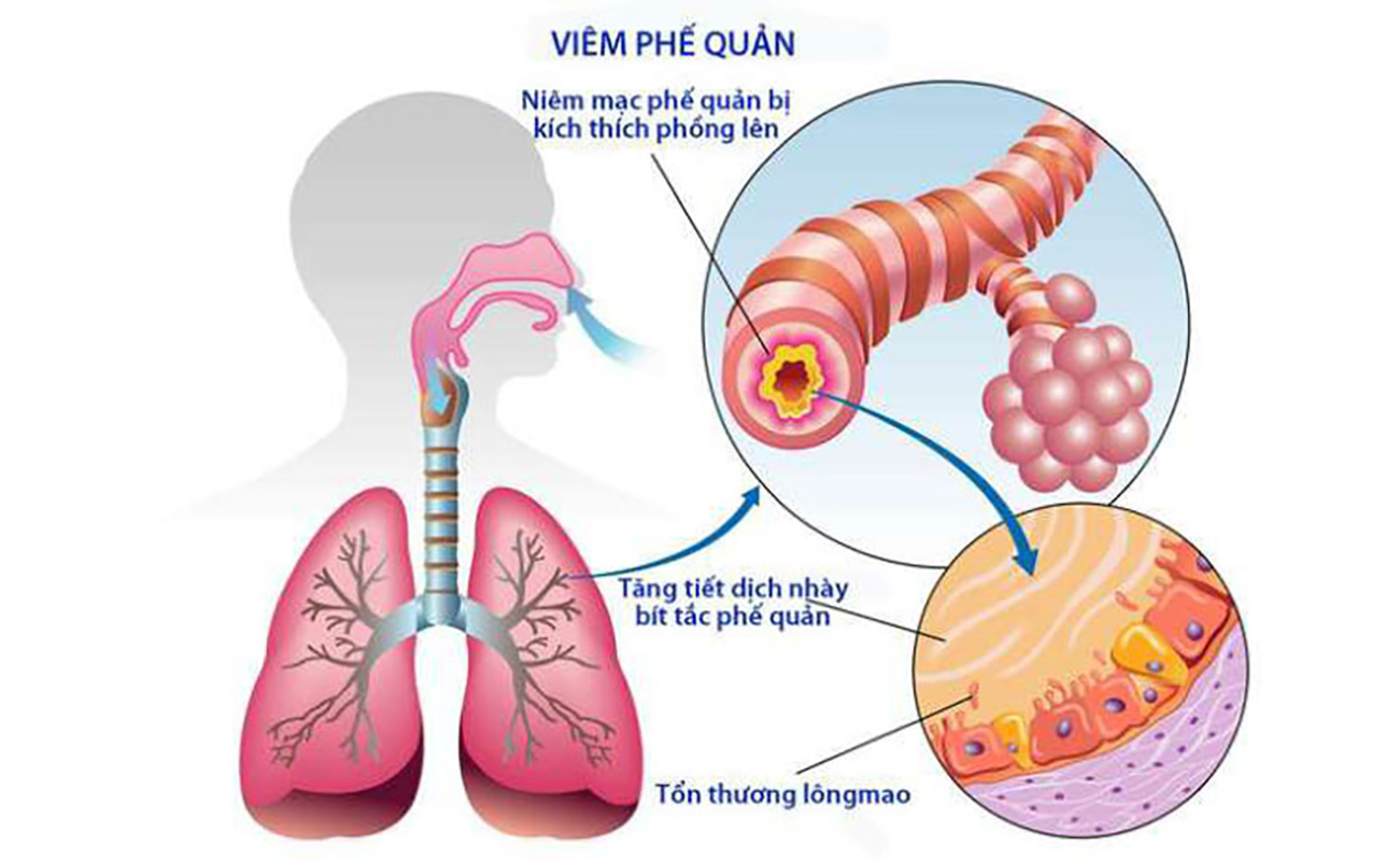 “Bật mí” giải pháp cải thiện triệu chứng viêm phế quản