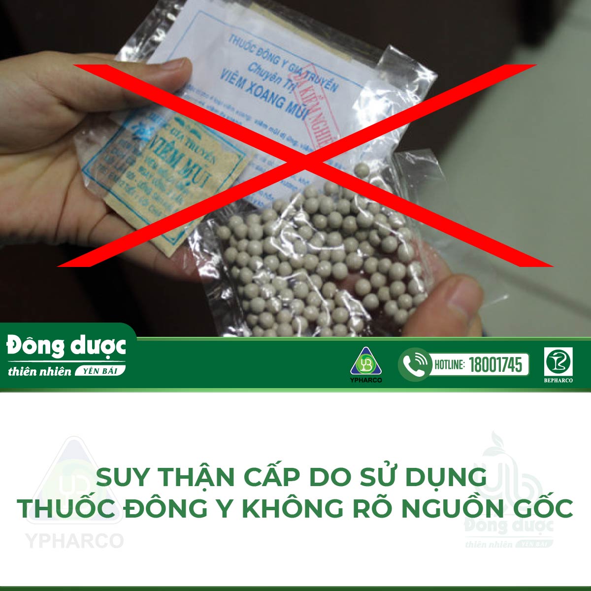 Suy thận cấp do sử dụng thuốc đông y không rõ nguồn gốc